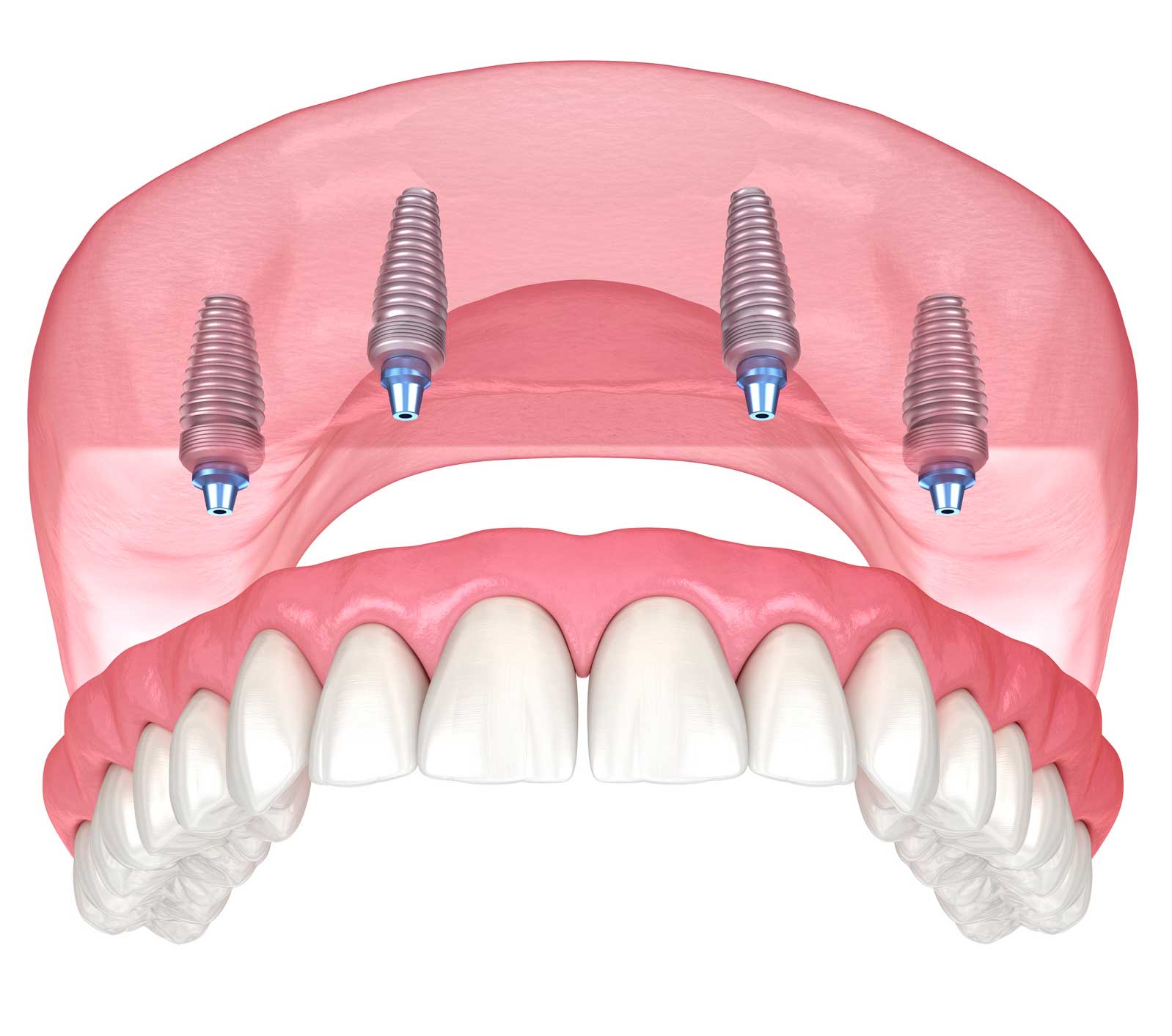 Implantes dentales en Los Realejos, Clínica dental en Los Realejos, Dentista en Los Realejos